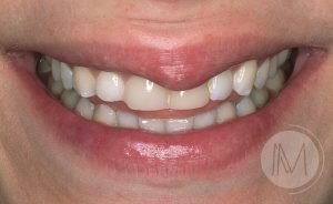 carillas-dentales-1