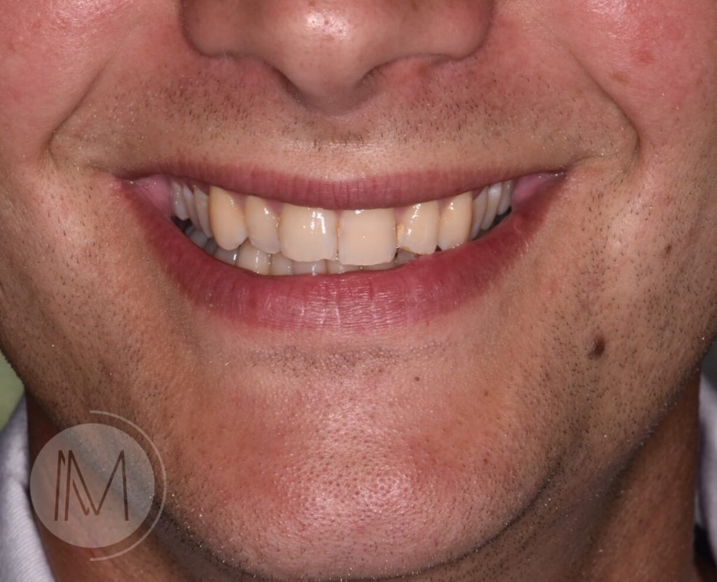 Ortodoncia + microimplante para corregir sonrisa inclinada 1