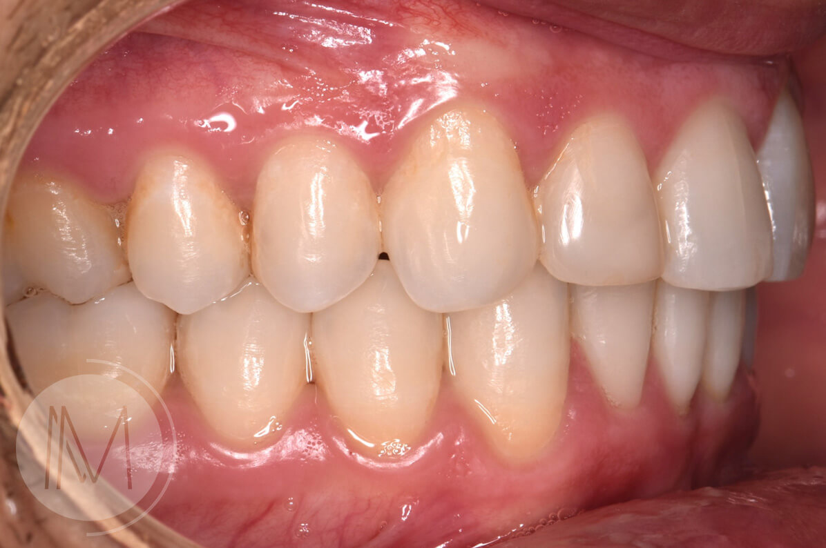 Ortodoncia + microimplante para corregir sonrisa inclinada 10