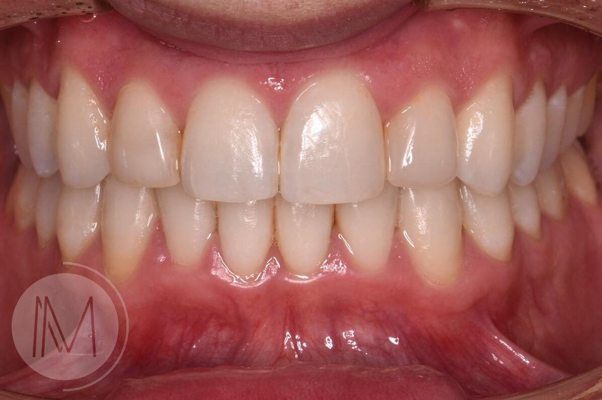 Ortodoncia + microimplante para corregir sonrisa inclinada 11