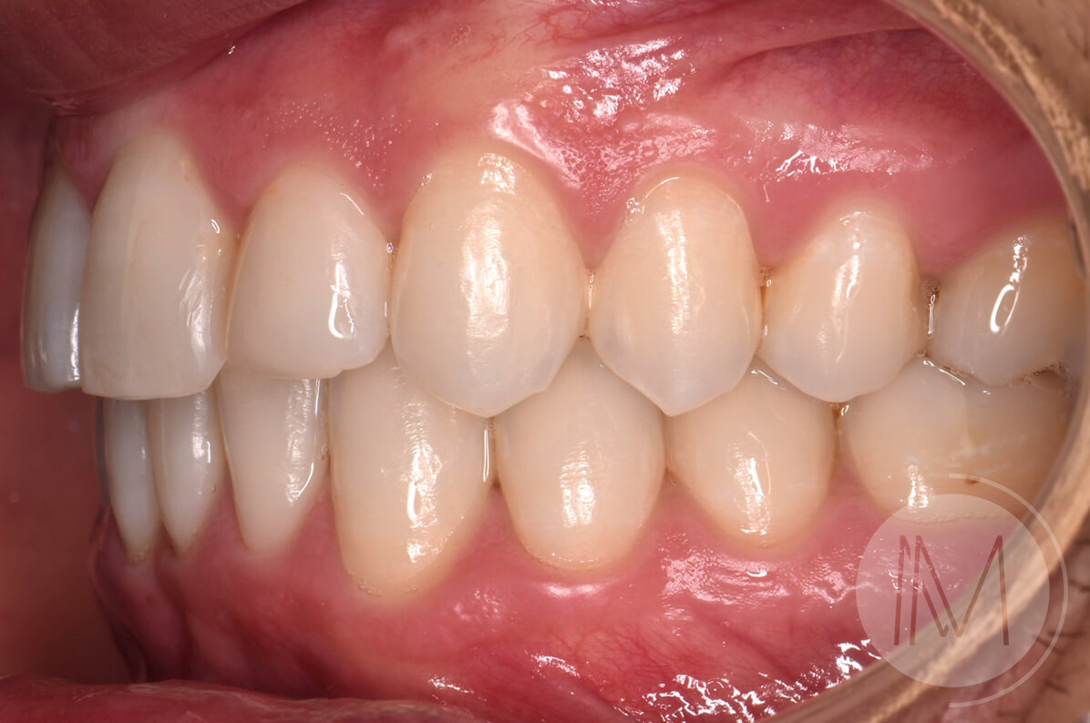 Ortodoncia + microimplante para corregir sonrisa inclinada 12