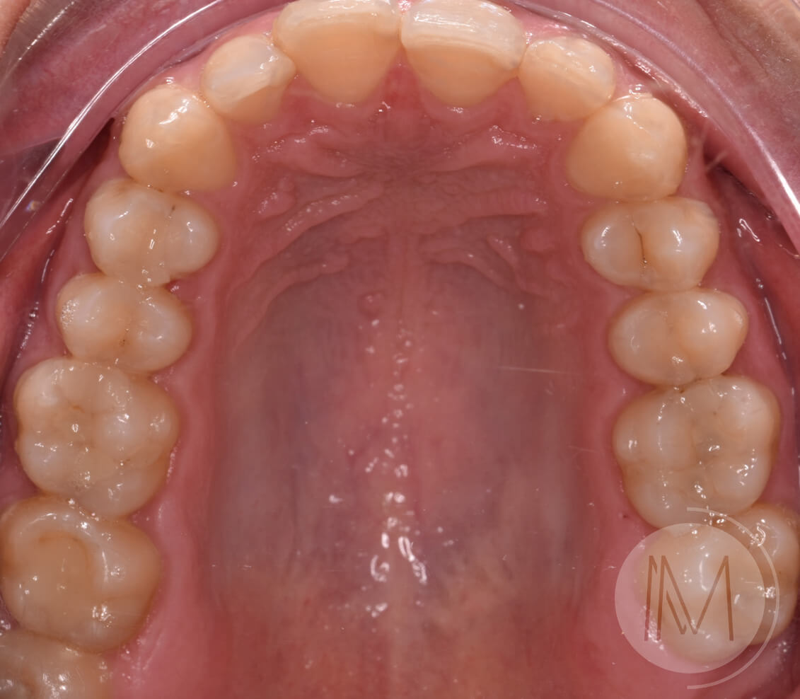Ortodoncia + microimplante para corregir sonrisa inclinada 13