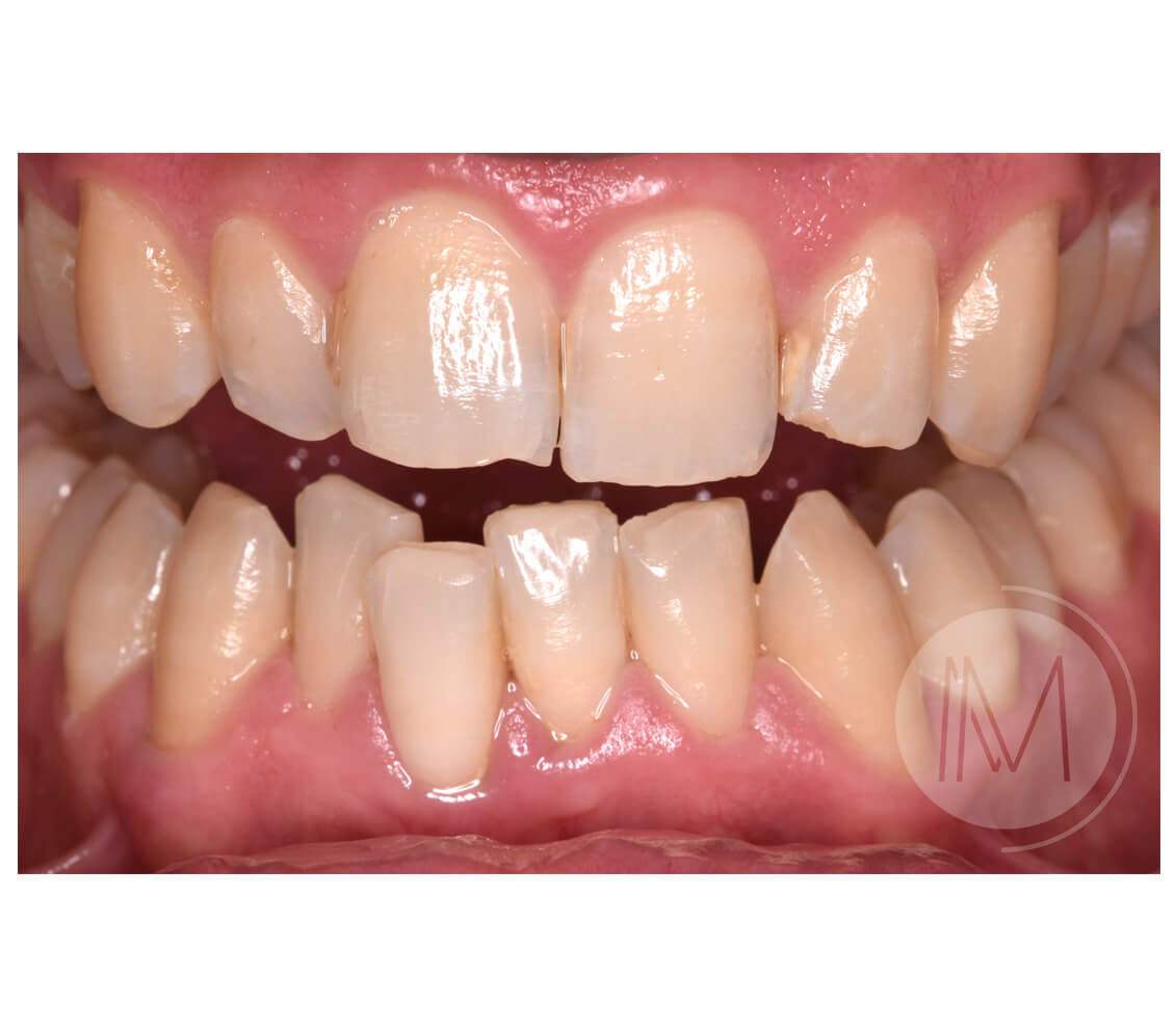 Ortodoncia + microimplante para corregir sonrisa inclinada 14