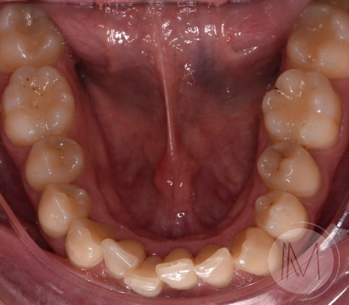 Ortodoncia + microimplante para corregir sonrisa inclinada 15