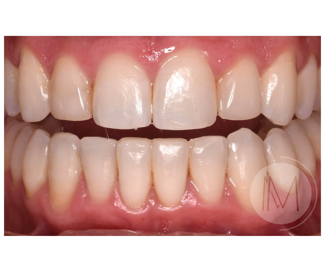 Ortodoncia + microimplante para corregir sonrisa inclinada 17