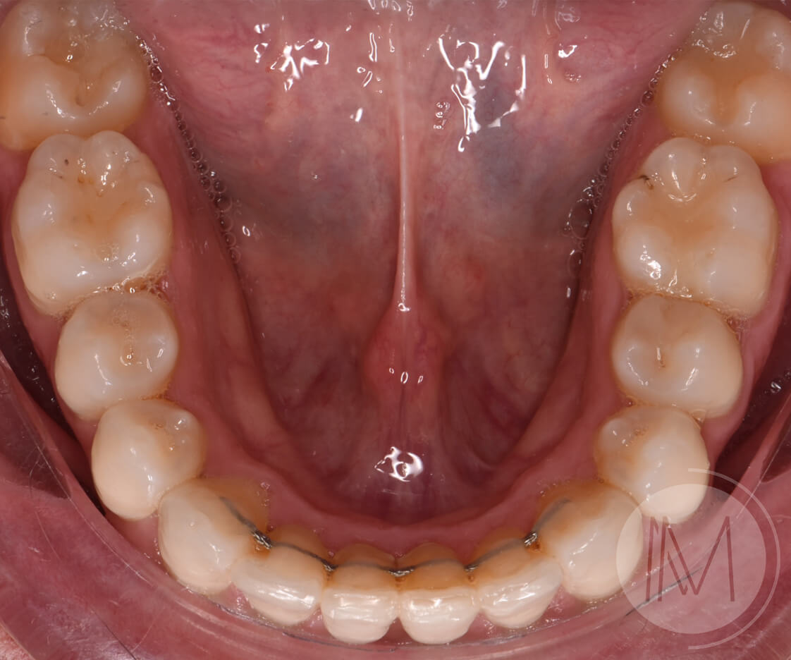 Ortodoncia + microimplante para corregir sonrisa inclinada 18