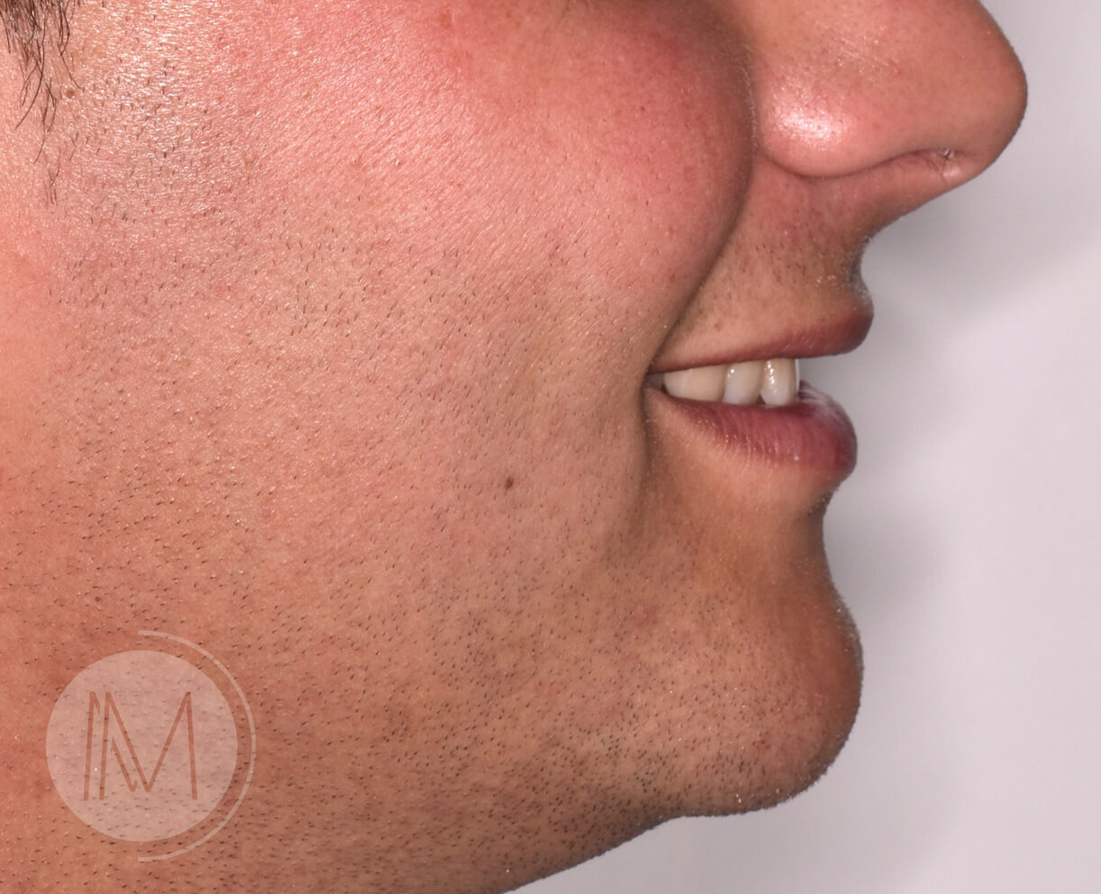 Ortodoncia + microimplante para corregir sonrisa inclinada 2