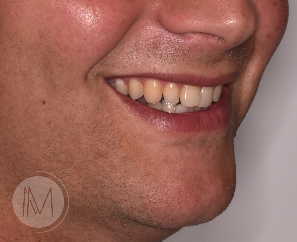 Ortodoncia + microimplante para corregir sonrisa inclinada 3