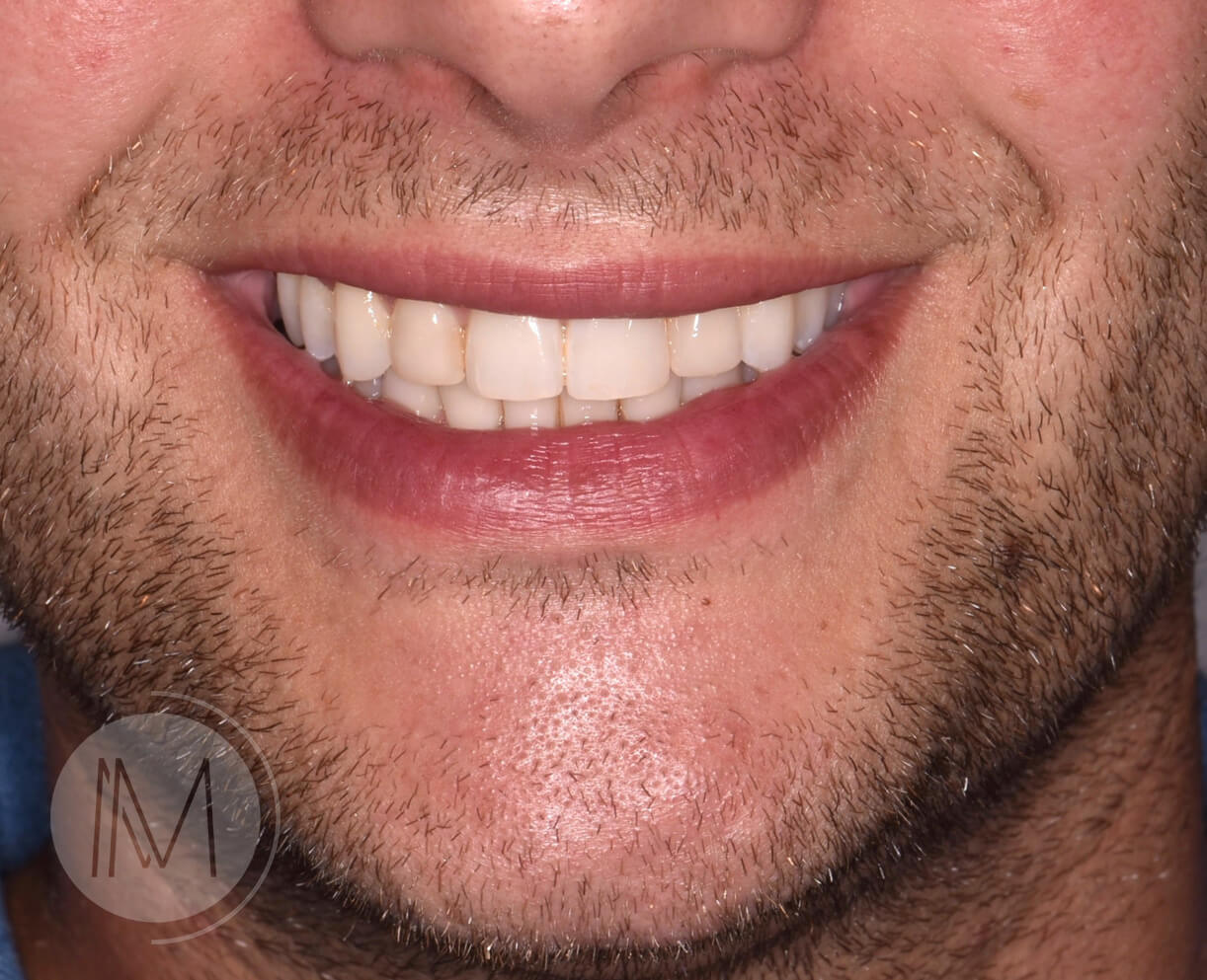 Ortodoncia + microimplante para corregir sonrisa inclinada 4