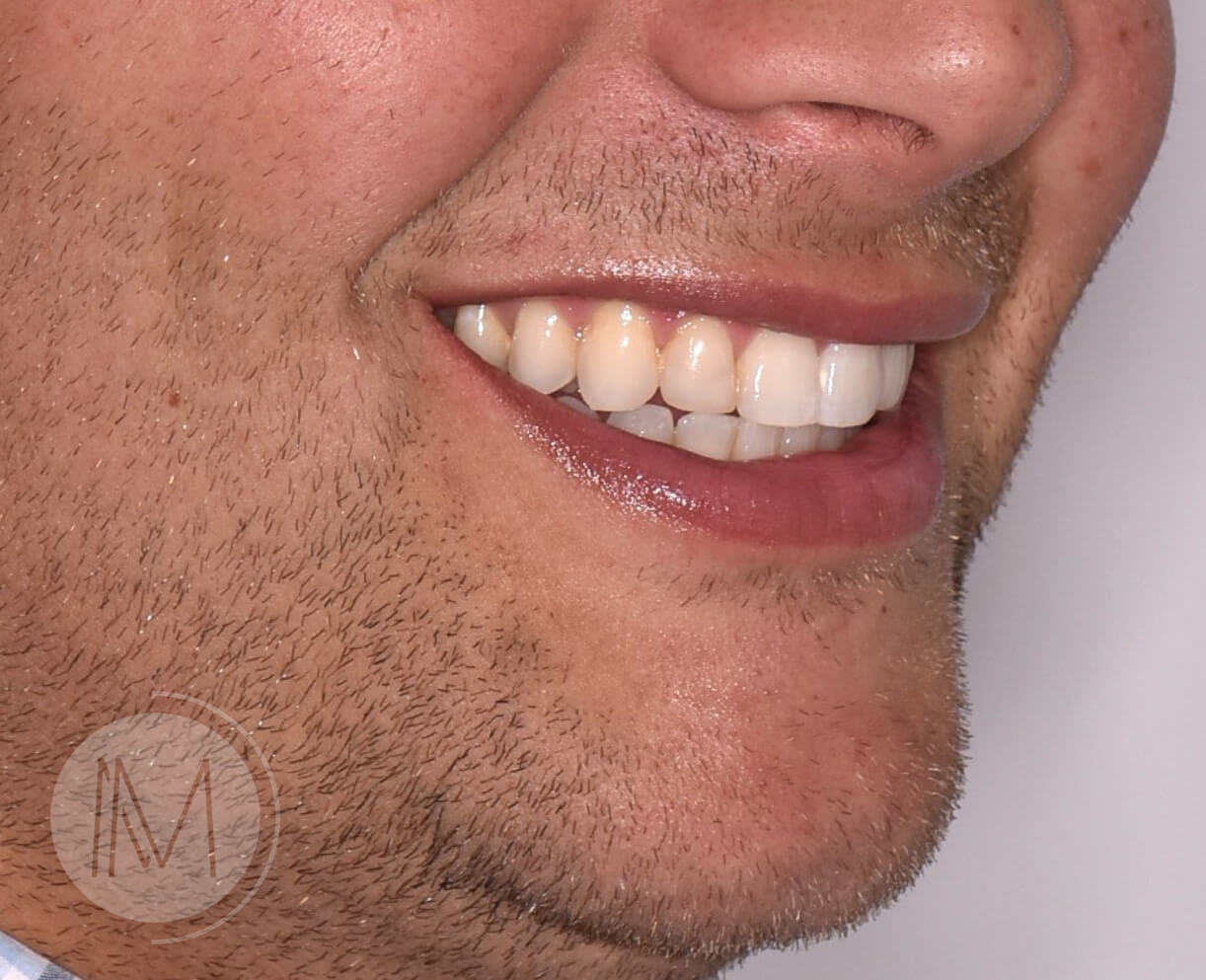 Ortodoncia + microimplante para corregir sonrisa inclinada 6