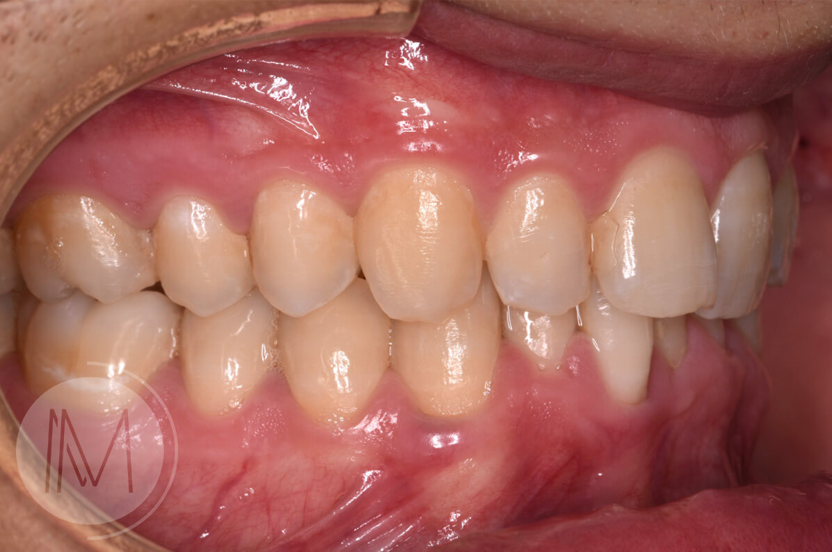 Ortodoncia + microimplante para corregir sonrisa inclinada 7
