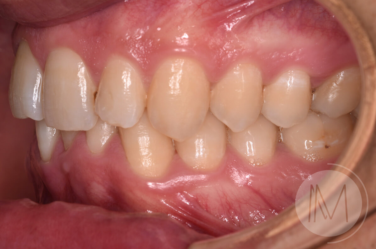 Ortodoncia + microimplante para corregir sonrisa inclinada 9
