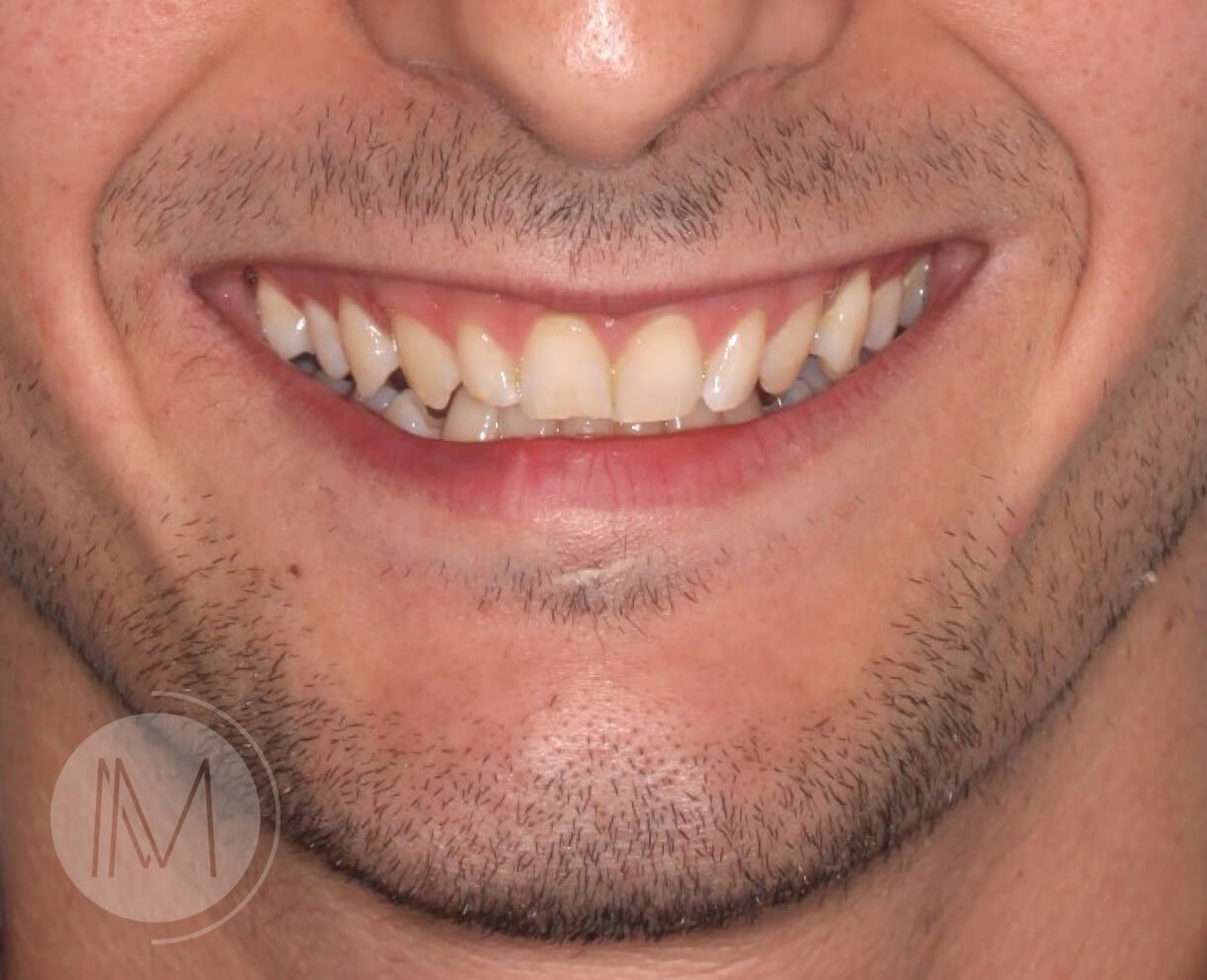 Tratamiento de ortodoncia por severos desgastes dentales 1