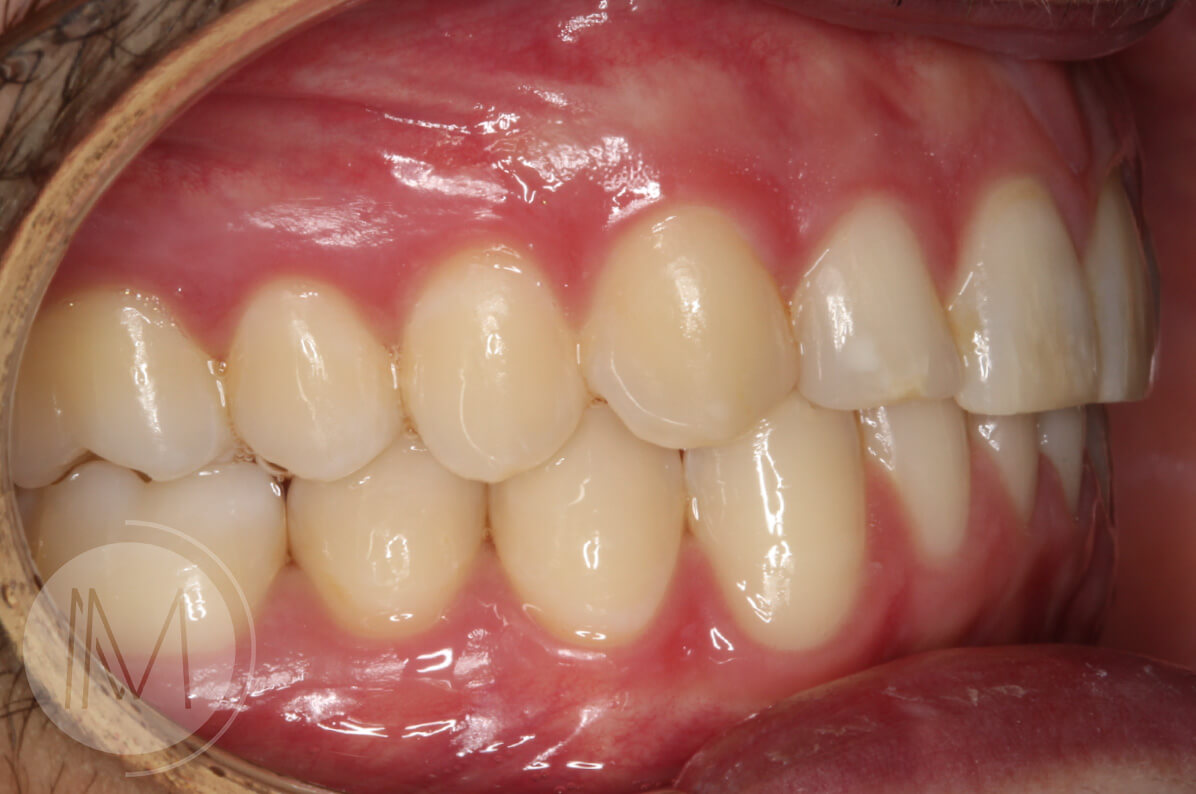 Tratamiento de ortodoncia por severos desgastes dentales 10