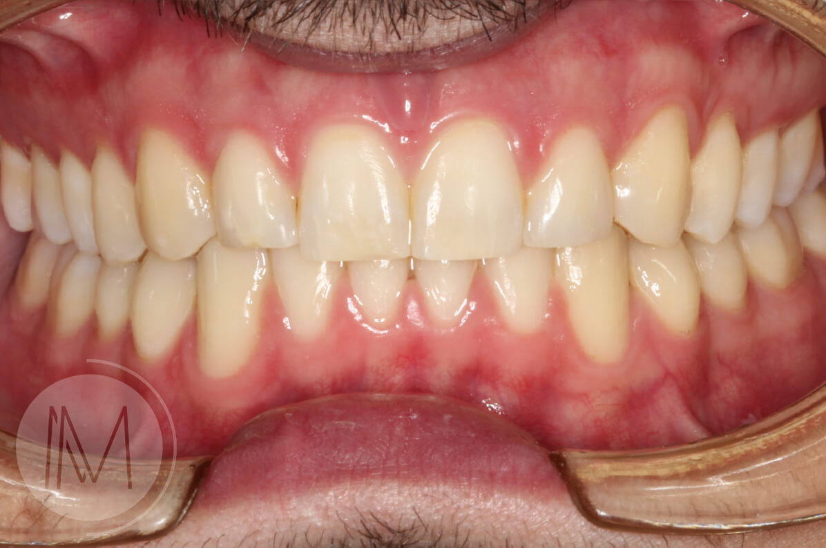 Tratamiento de ortodoncia por severos desgastes dentales 11