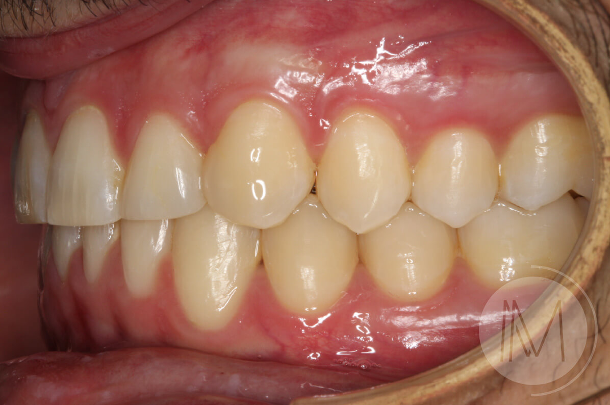 Tratamiento de ortodoncia por severos desgastes dentales 12