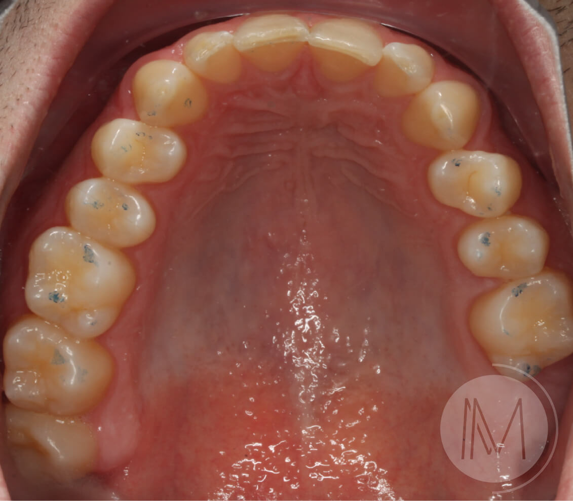 Tratamiento de ortodoncia por severos desgastes dentales 13