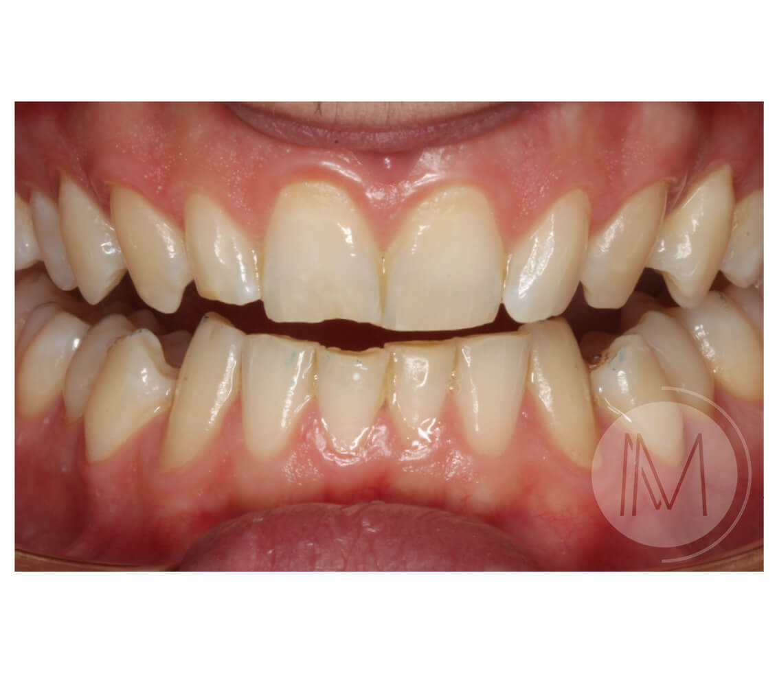 Tratamiento de ortodoncia por severos desgastes dentales 14