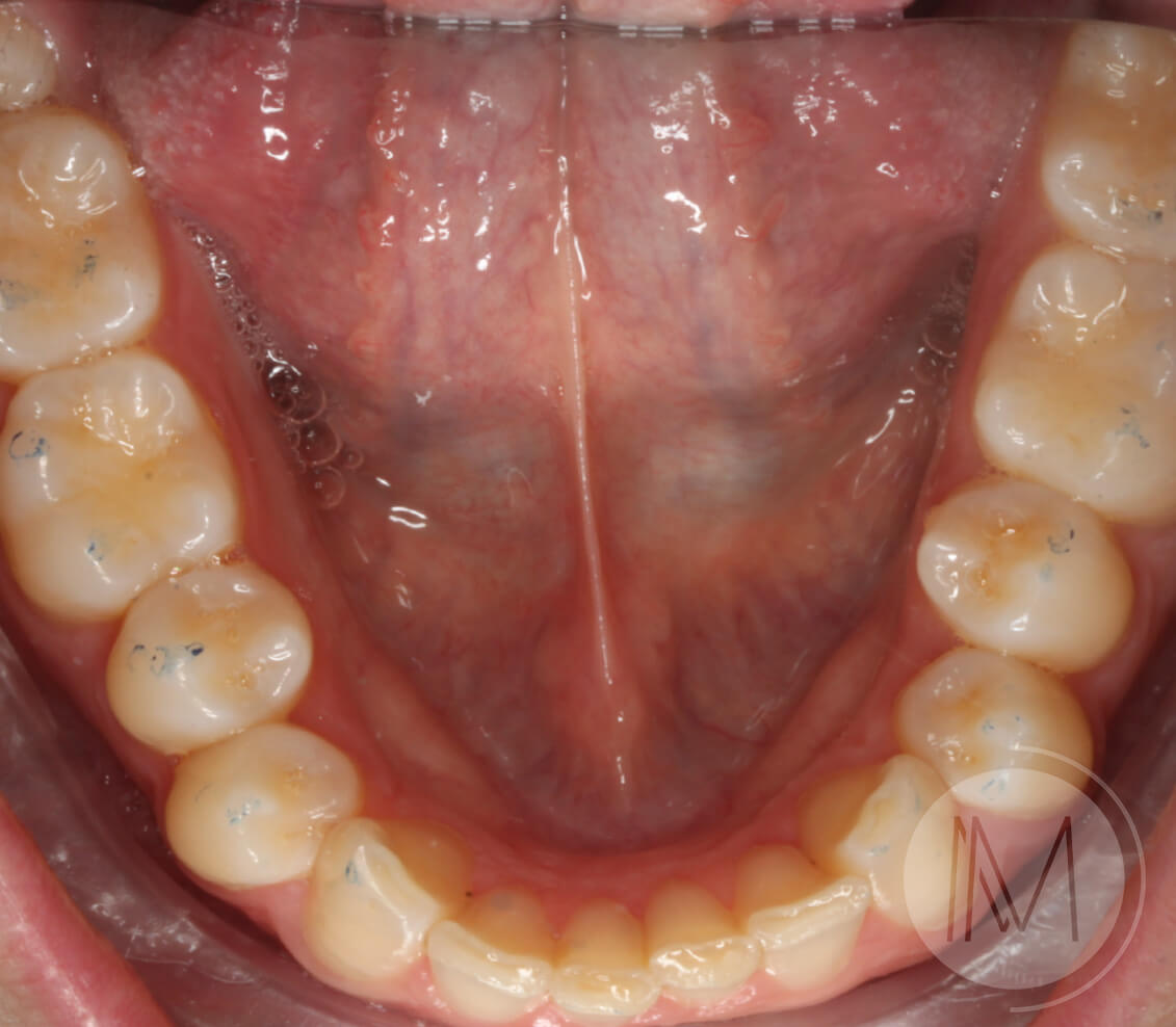 Tratamiento de ortodoncia por severos desgastes dentales 15