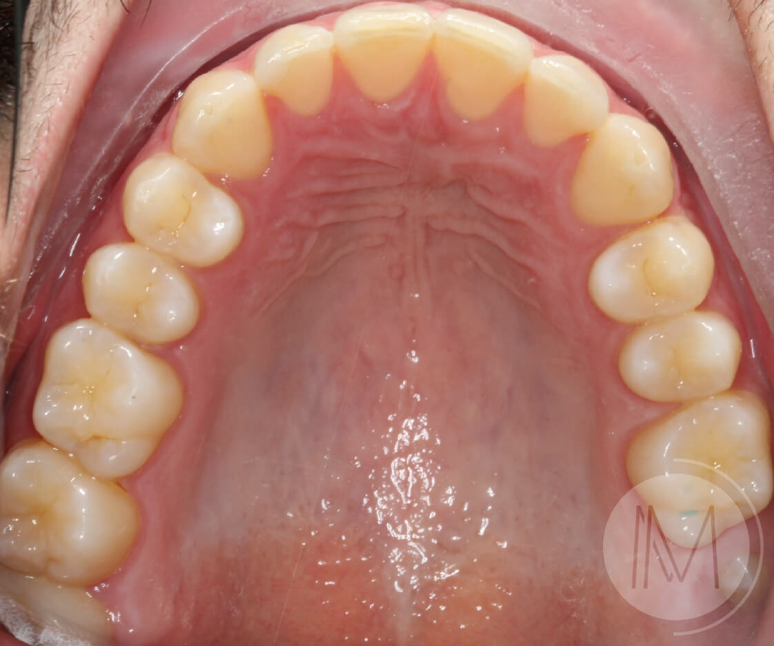 Tratamiento de ortodoncia por severos desgastes dentales 16
