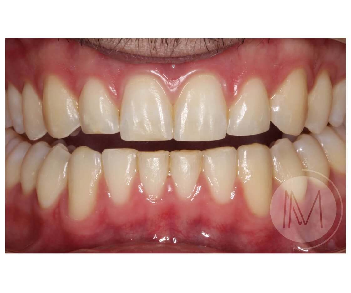 Tratamiento de ortodoncia por severos desgastes dentales 17