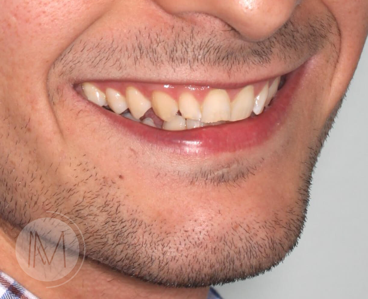 Tratamiento de ortodoncia por severos desgastes dentales 3