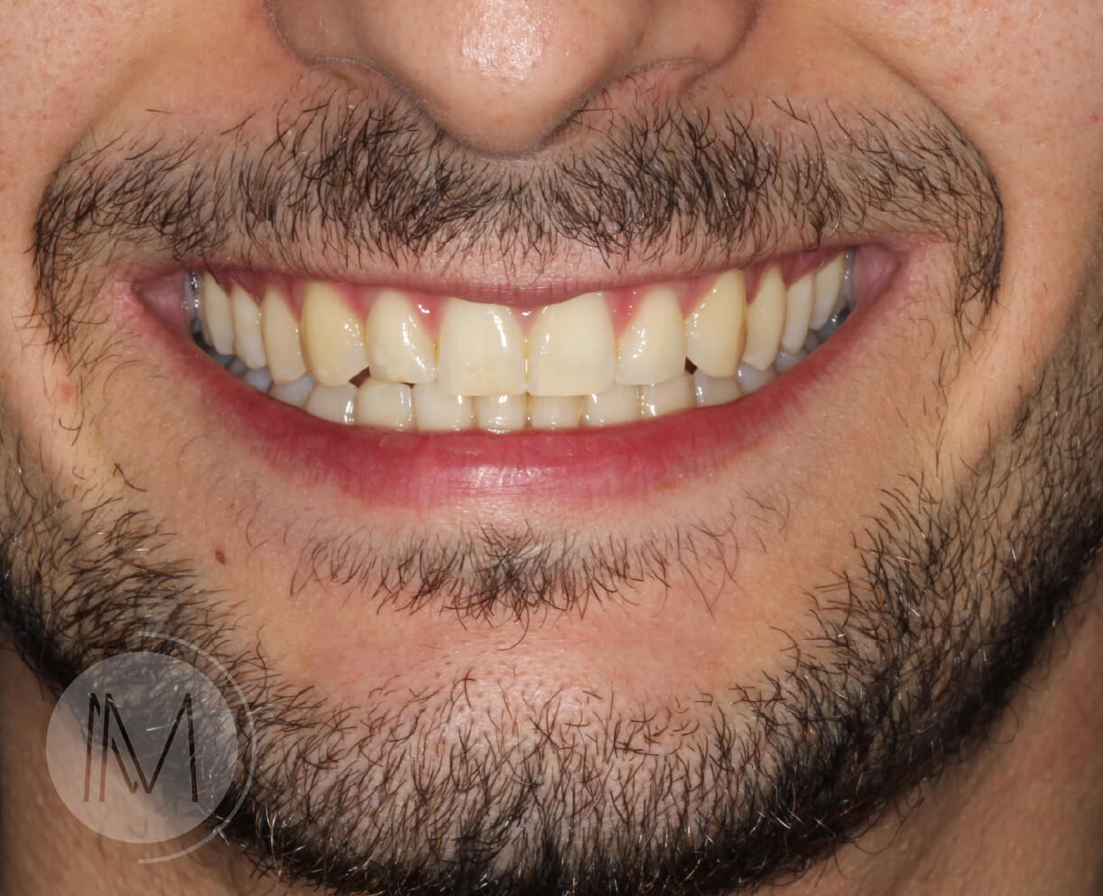 Tratamiento de ortodoncia por severos desgastes dentales 4
