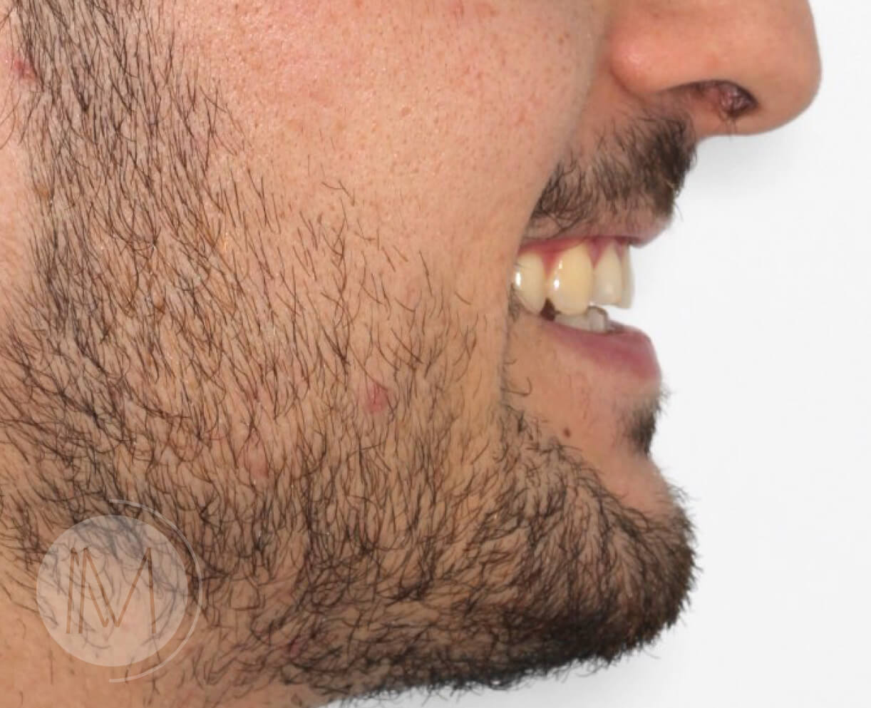 Tratamiento de ortodoncia por severos desgastes dentales 5
