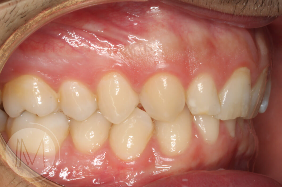 Tratamiento de ortodoncia por severos desgastes dentales 7