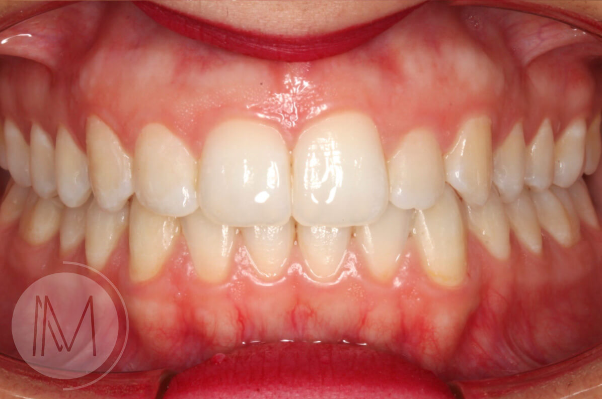 Tratamiento con Ortodoncia Invisible 5_14