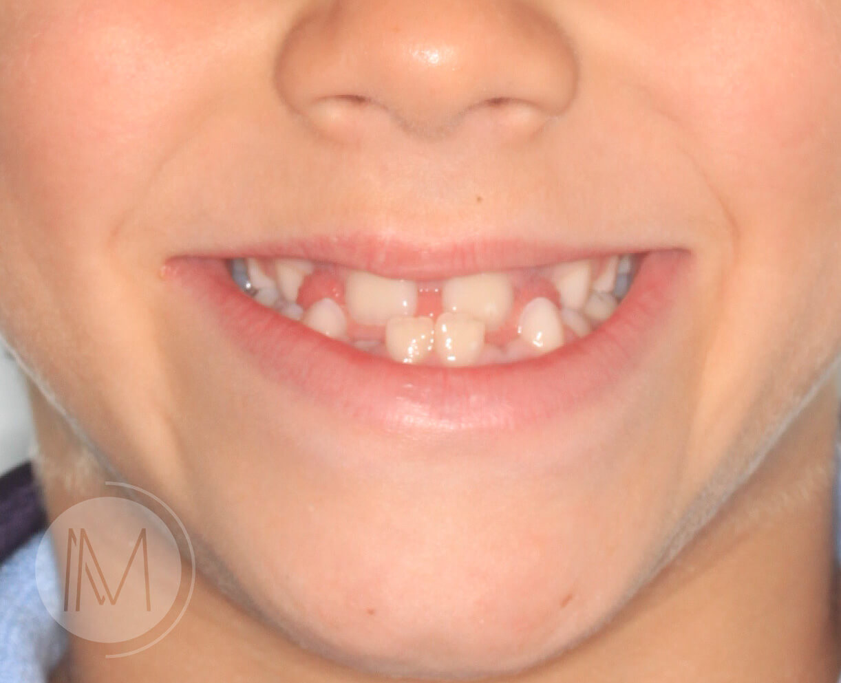 Ortodoncia infantil en paciente con mandíbula prominente 7_1