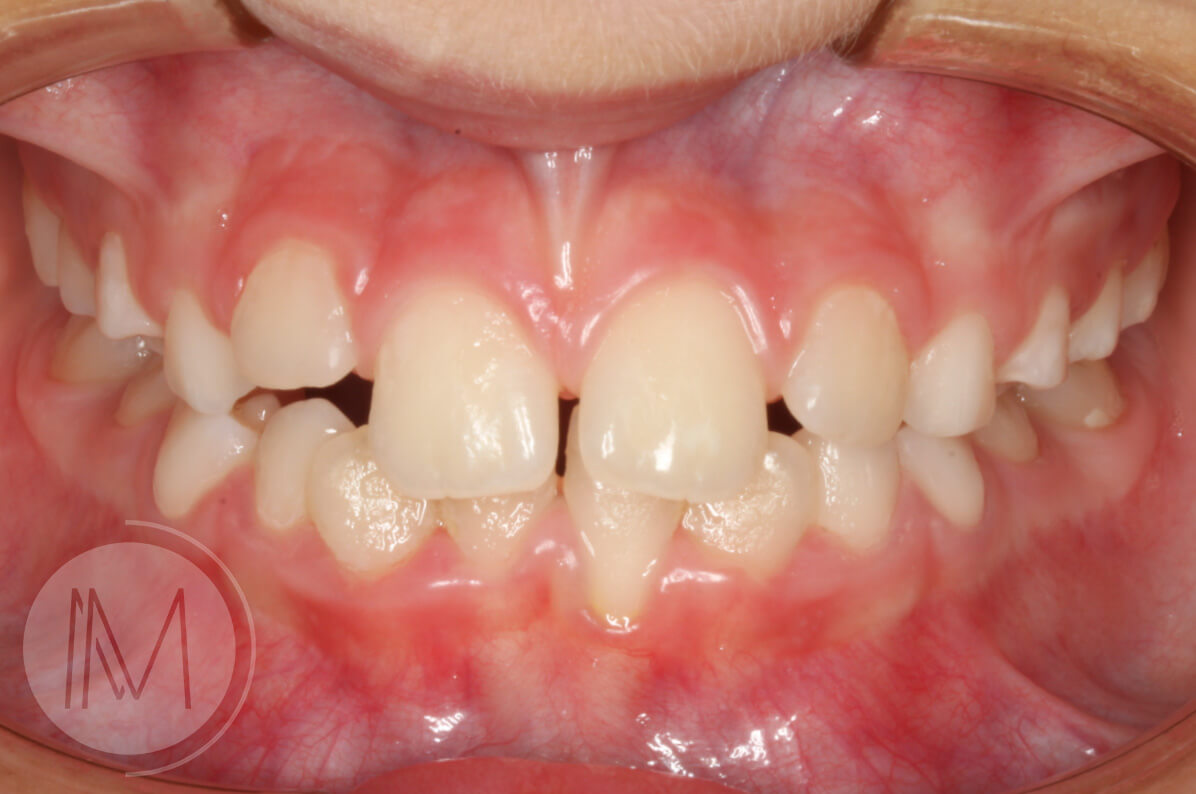 Ortodoncia infantil en paciente con mandíbula prominente 7_11