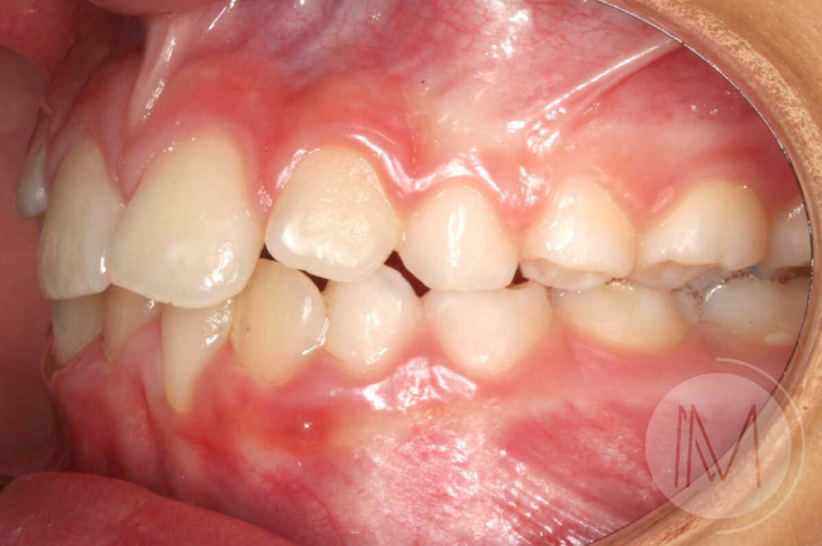 Ortodoncia infantil en paciente con mandíbula prominente 7_12