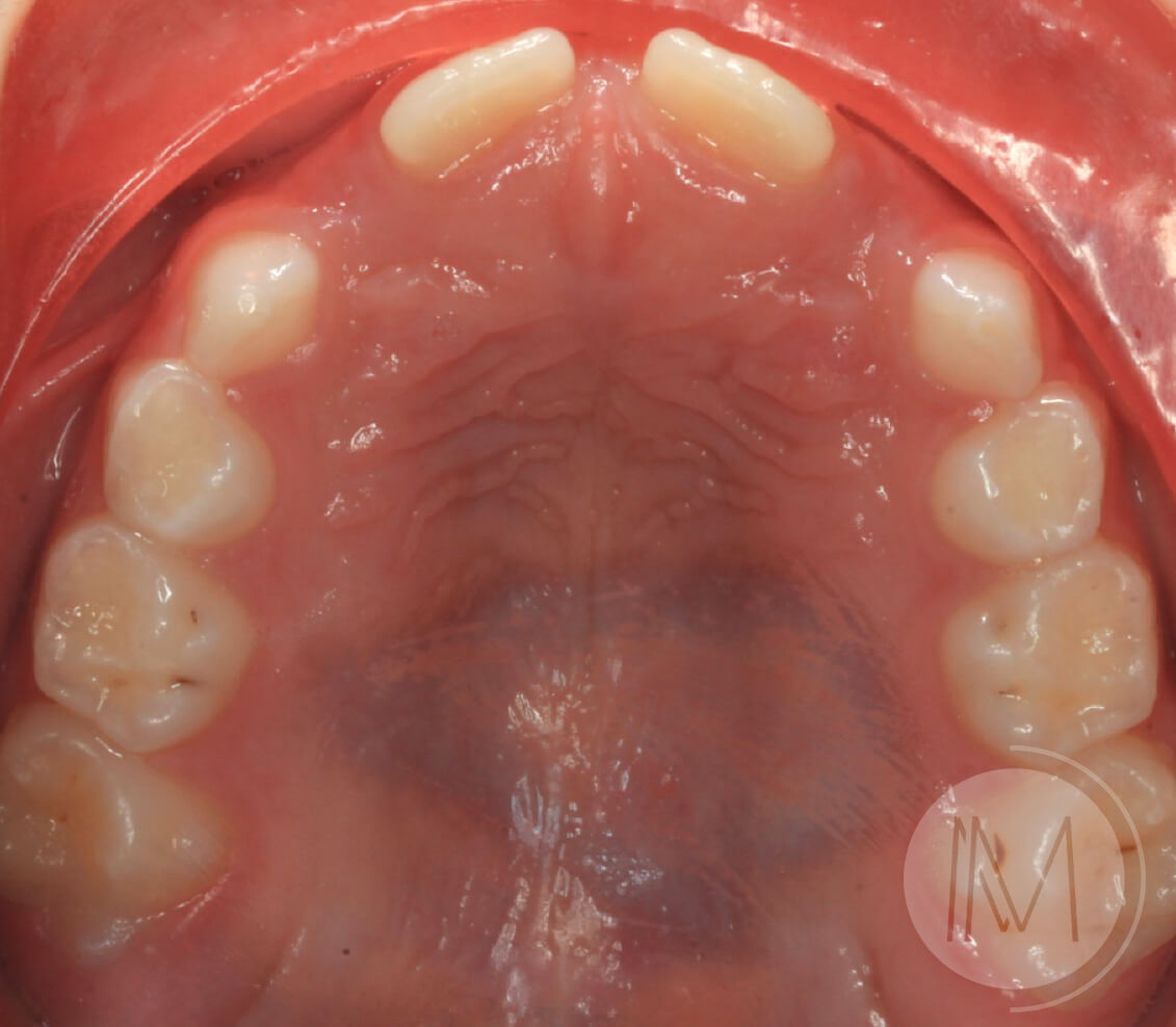 Ortodoncia infantil en paciente con mandíbula prominente 7_13
