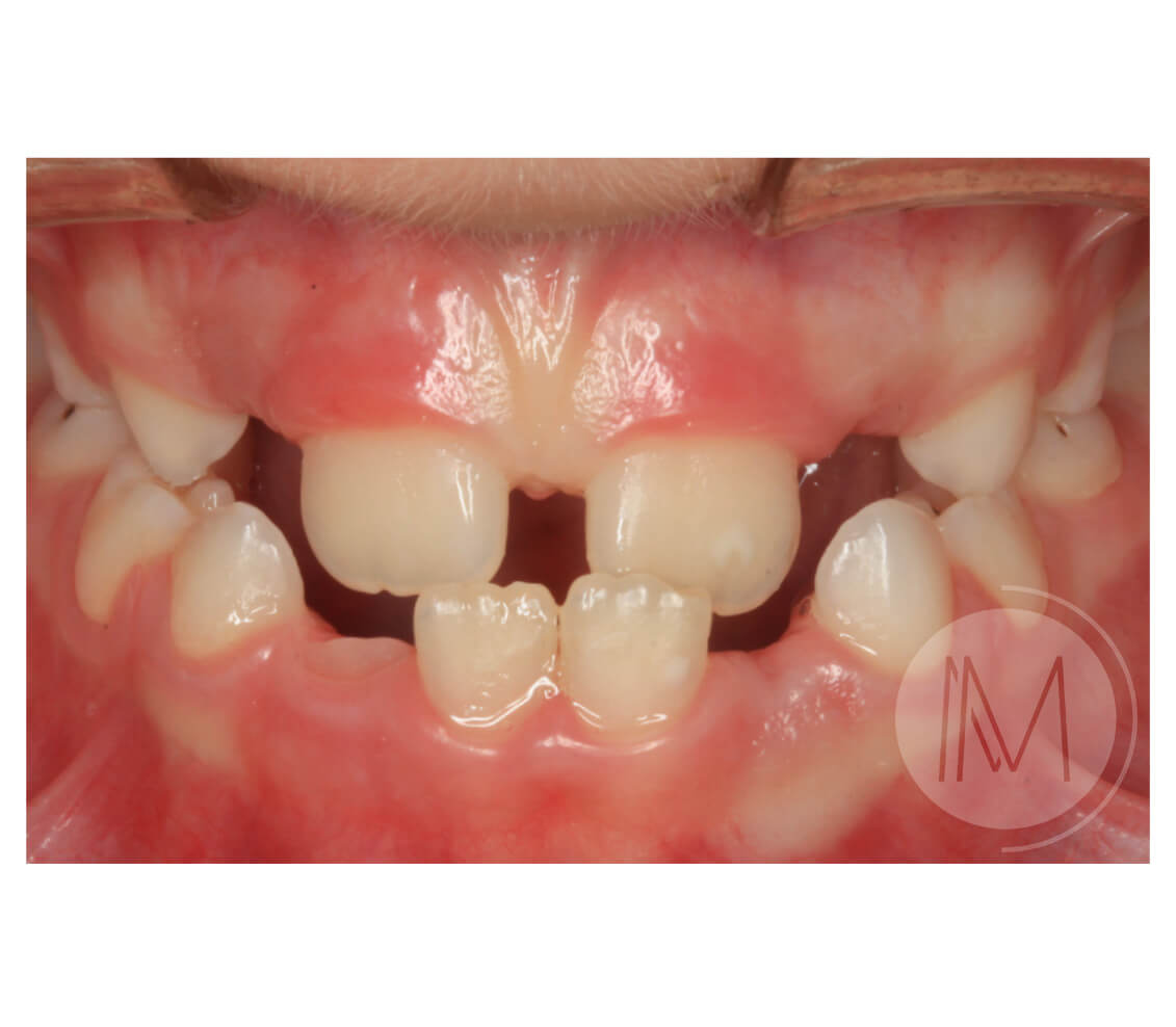 Ortodoncia infantil en paciente con mandíbula prominente 7_14