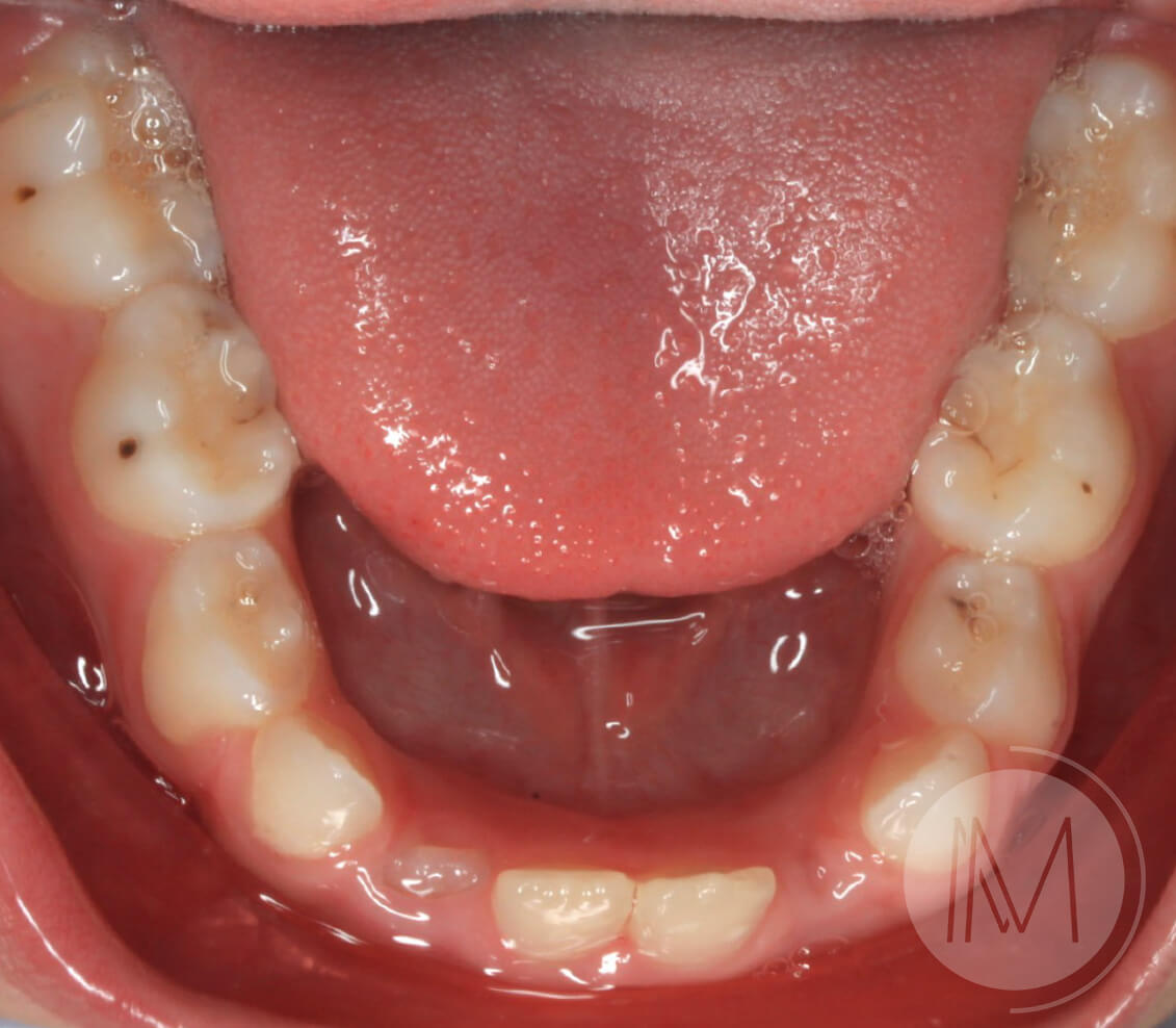 Ortodoncia infantil en paciente con mandíbula prominente 7_15