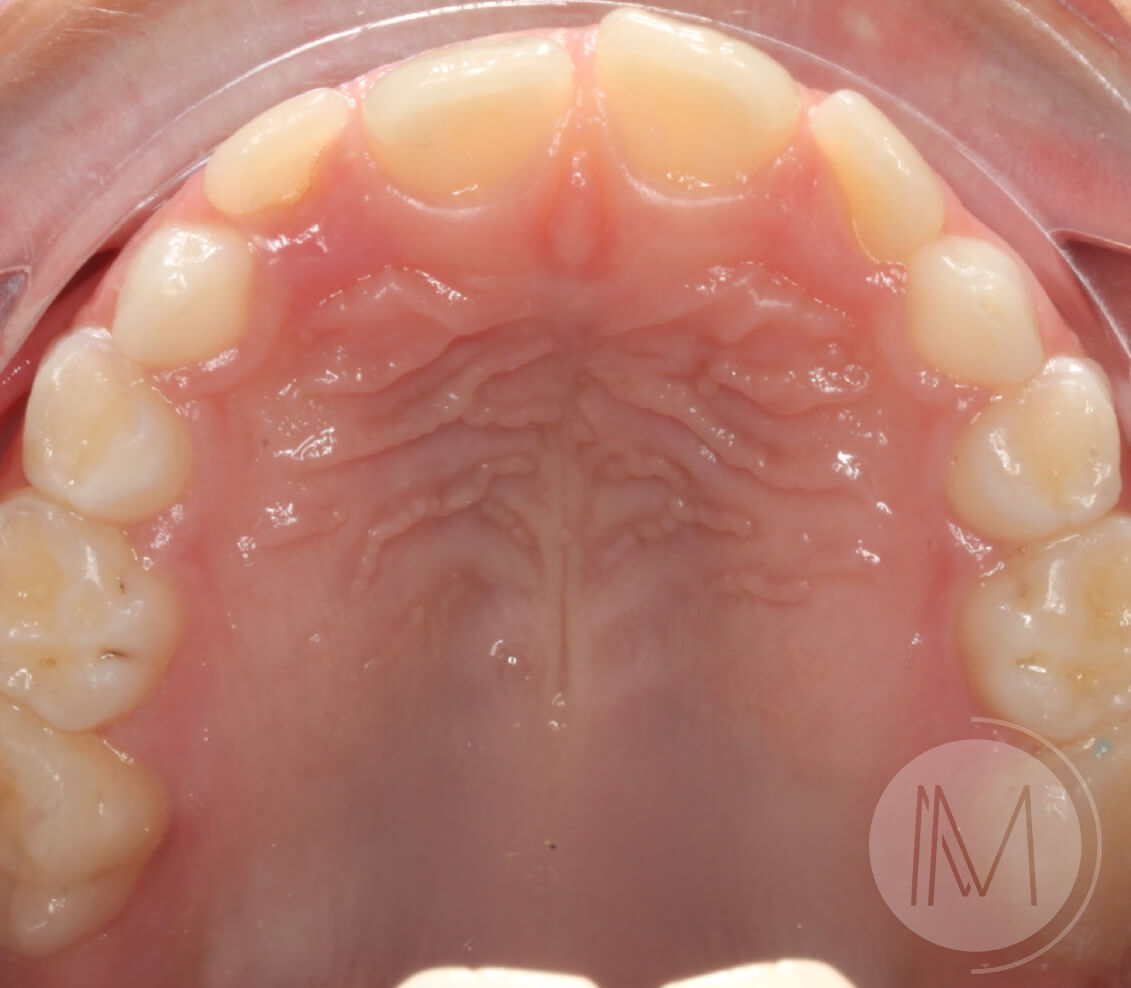 Ortodoncia infantil en paciente con mandíbula prominente 7_16