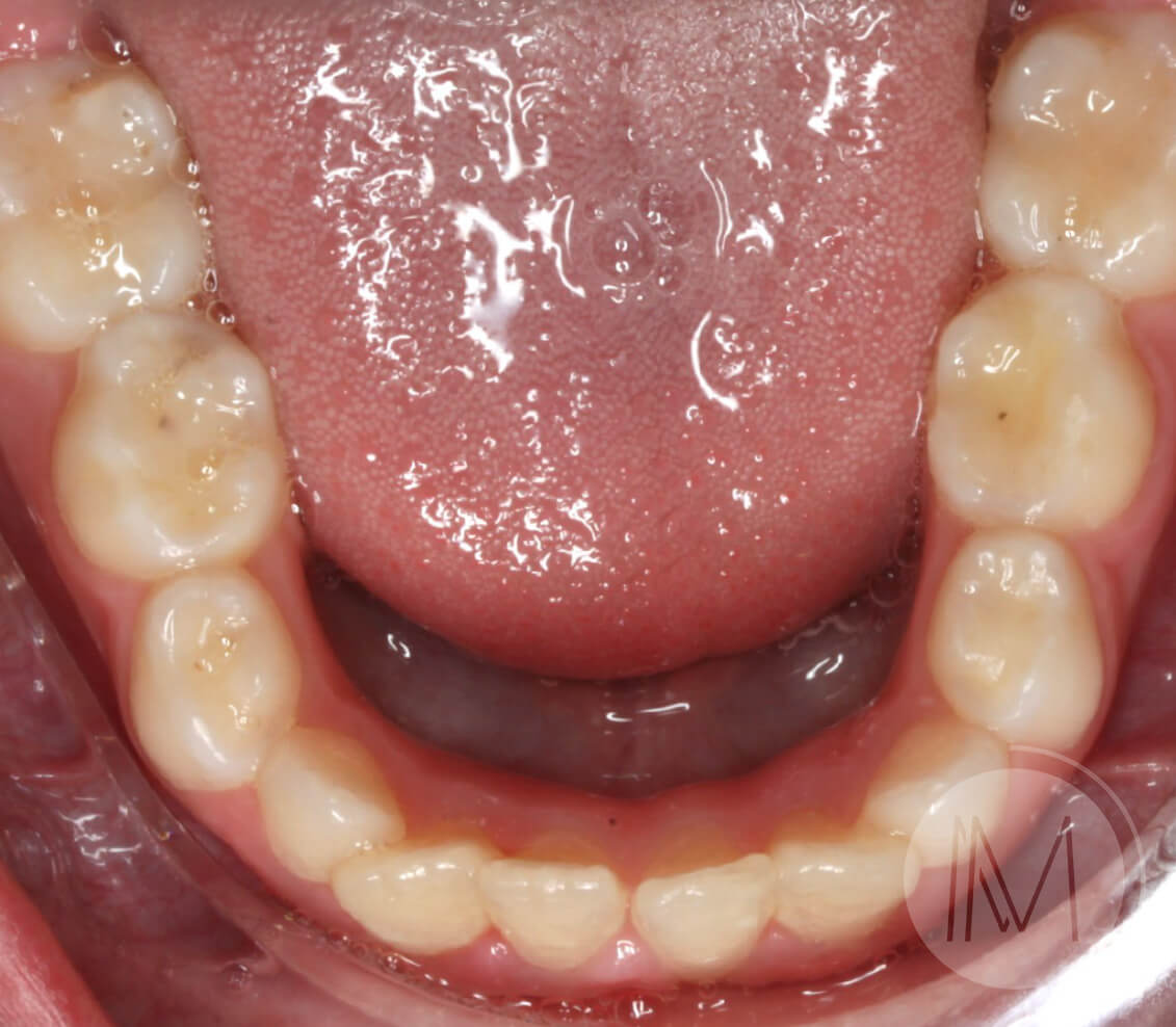 Ortodoncia infantil en paciente con mandíbula prominente 7_18