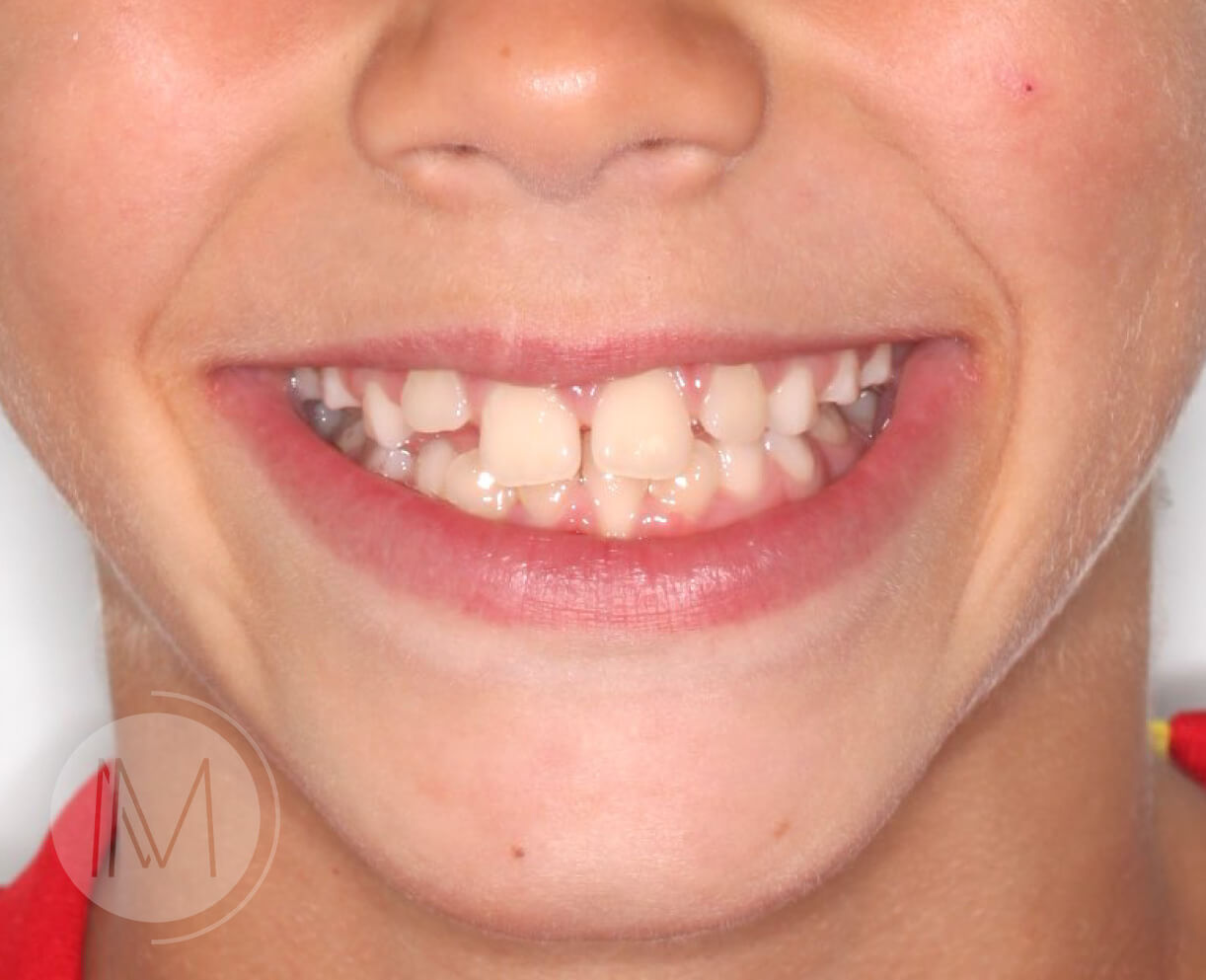 Ortodoncia infantil en paciente con mandíbula prominente 7_4