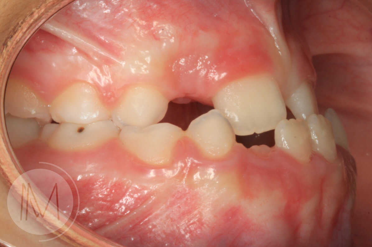 Ortodoncia infantil en paciente con mandíbula prominente 7_7
