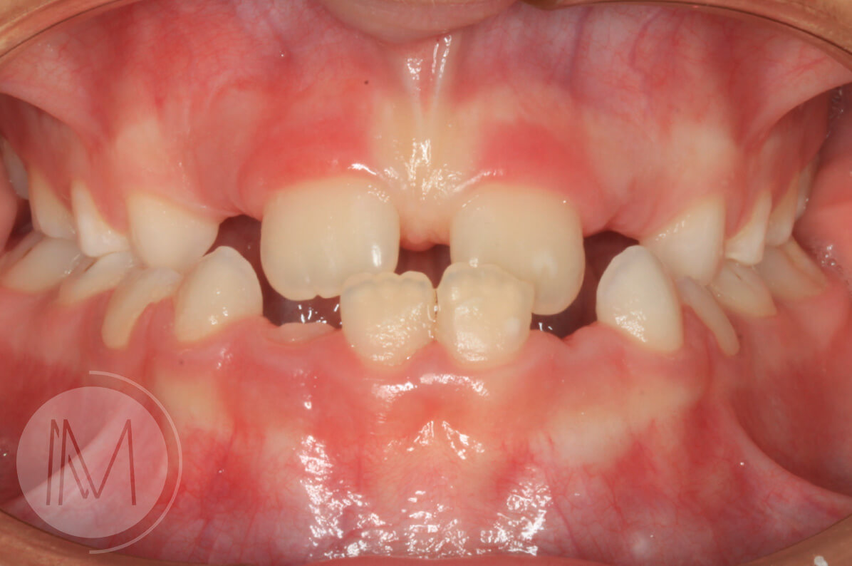 Ortodoncia infantil en paciente con mandíbula prominente 7_8
