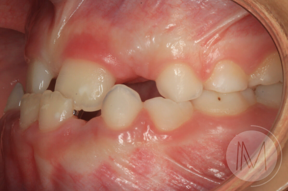 Ortodoncia infantil en paciente con mandíbula prominente 7_9