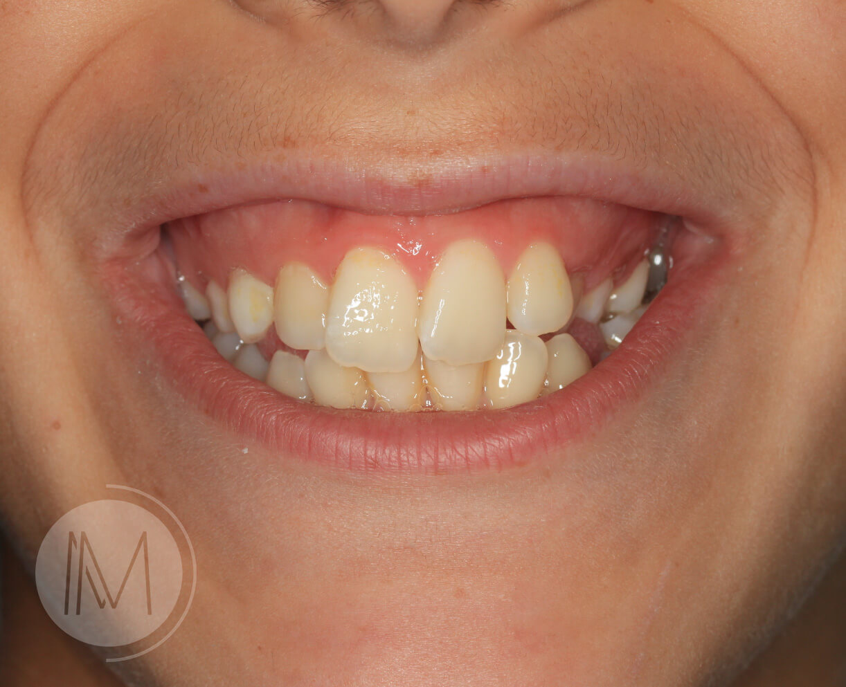 Ortodoncia infantil y Ortodoncia en adolescente 8_1