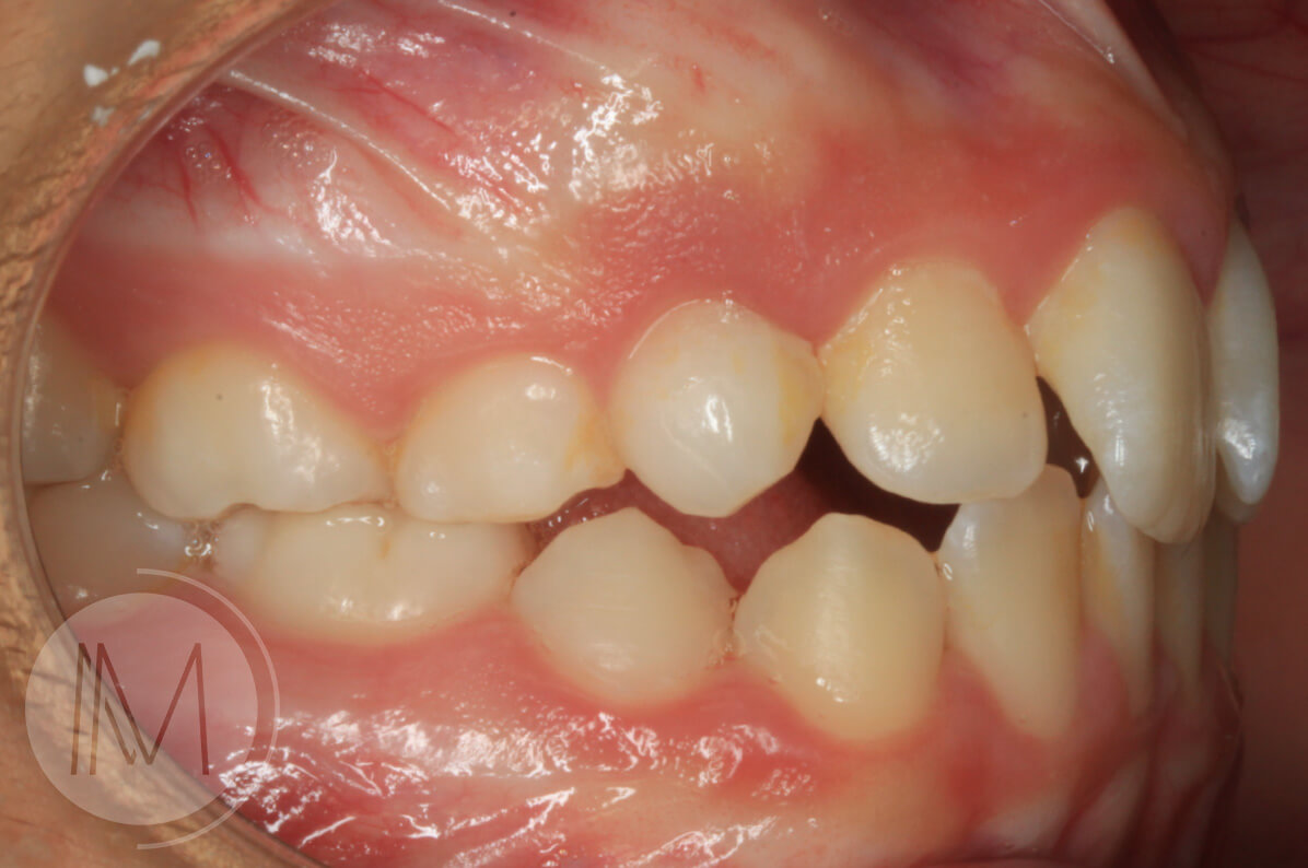 Ortodoncia infantil y Ortodoncia en adolescente 8_10