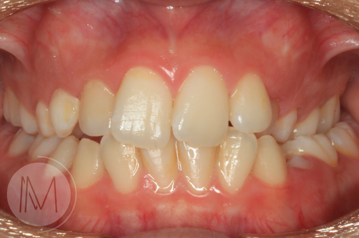 Ortodoncia infantil y Ortodoncia en adolescente 8_11