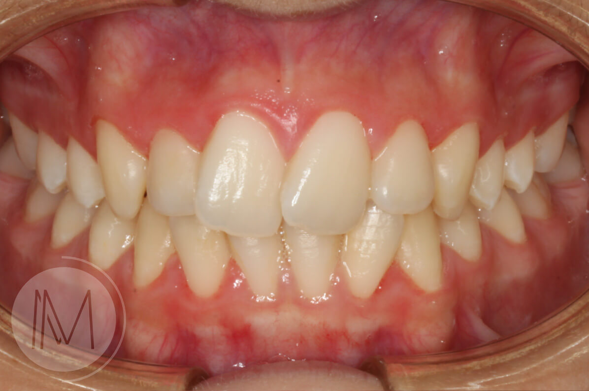Ortodoncia infantil y Ortodoncia en adolescente 8_14
