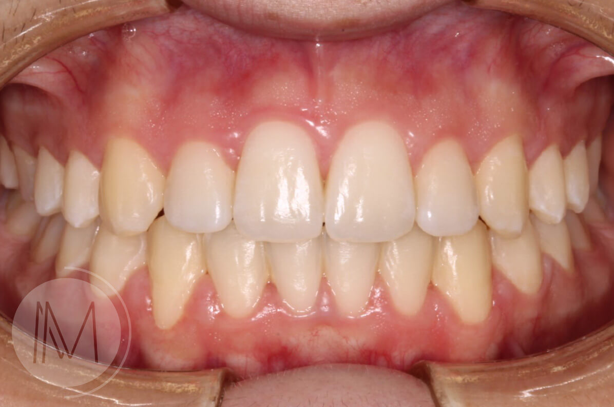 Ortodoncia infantil y Ortodoncia en adolescente 8_17