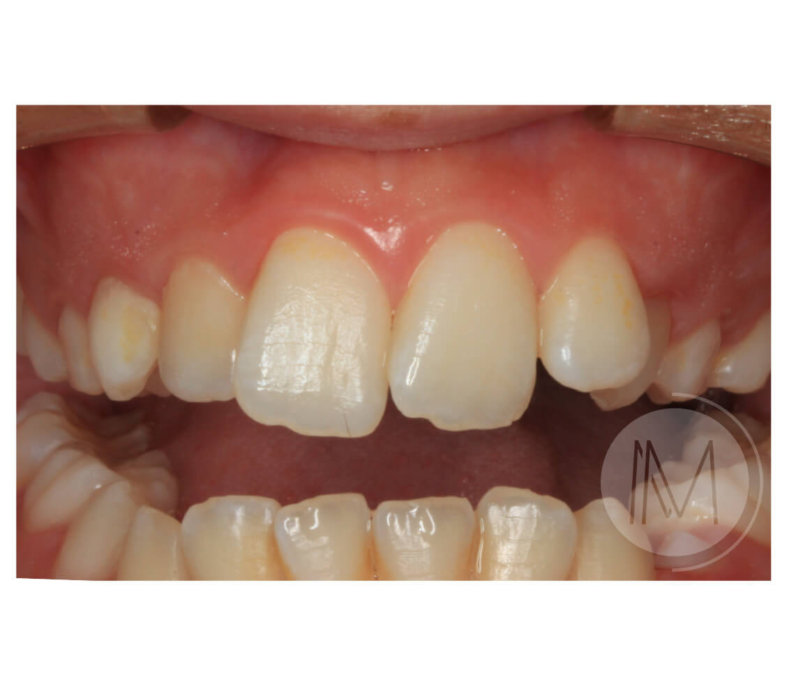 Ortodoncia infantil y Ortodoncia en adolescente 8_20
