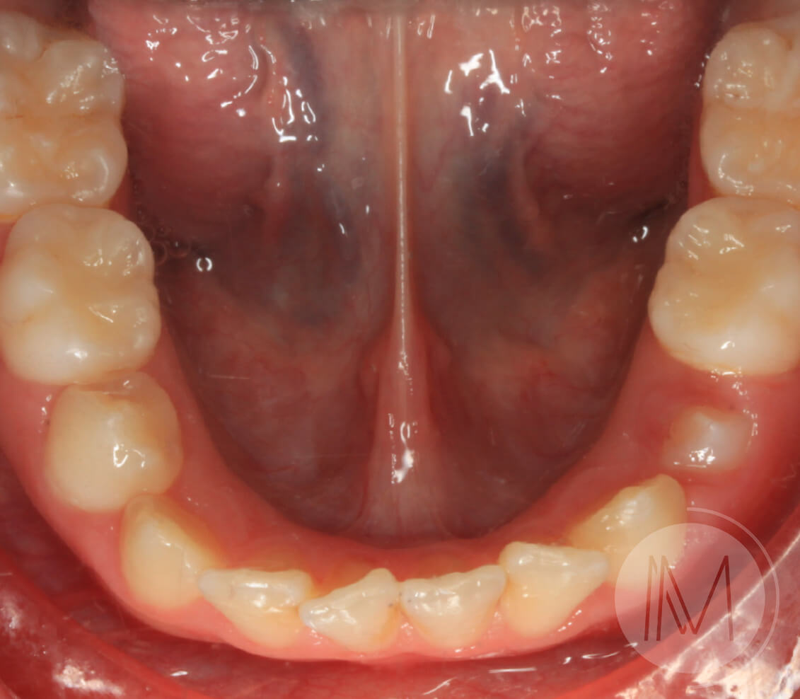 Ortodoncia infantil y Ortodoncia en adolescente 8_21