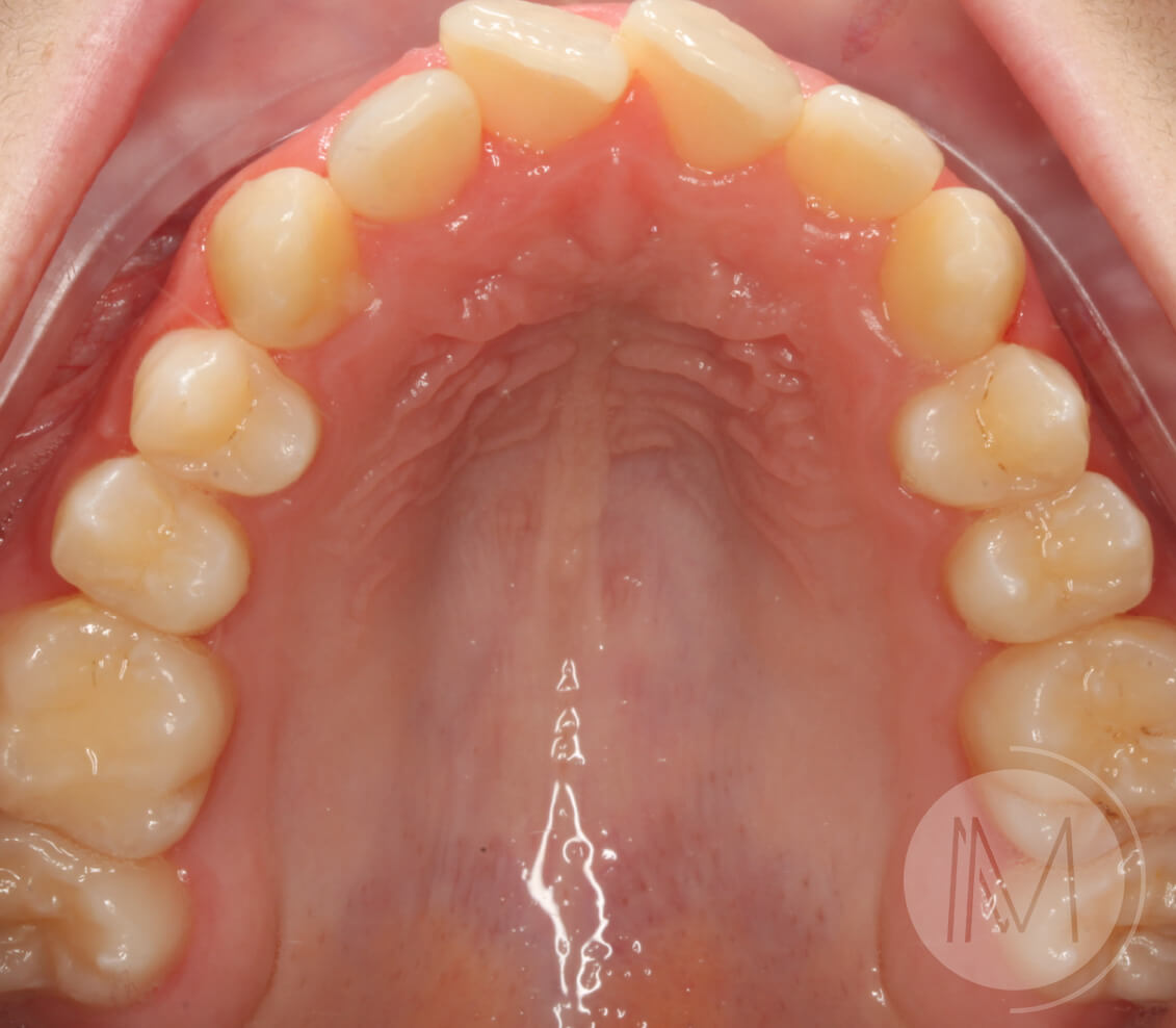 Ortodoncia infantil y Ortodoncia en adolescente 8_22